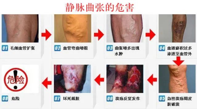 靜脈曲張危害.jpg 靜脈曲張危害.jpg